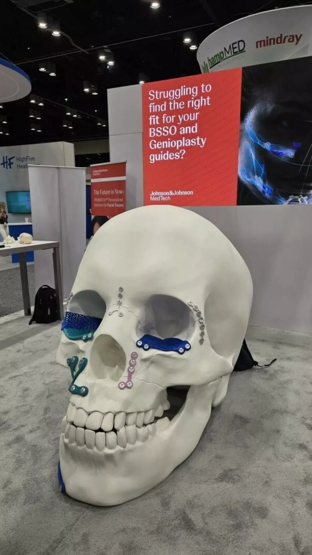 Johnson Johnson 3 D Printed Skull