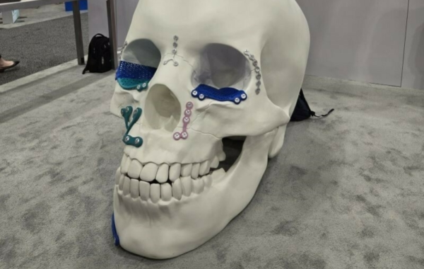 Johnson Johnson 3 D Printed Skull